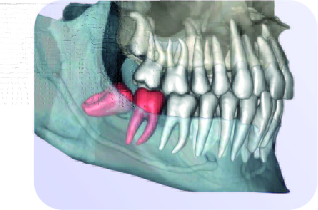 Diagnocat Segmentare STL